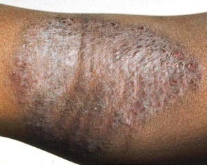 Eczema 2